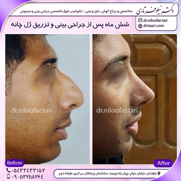 اقدامات قبل از جراحی بینی