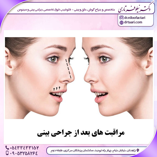 مراقبت های بعد از جراحی بینی