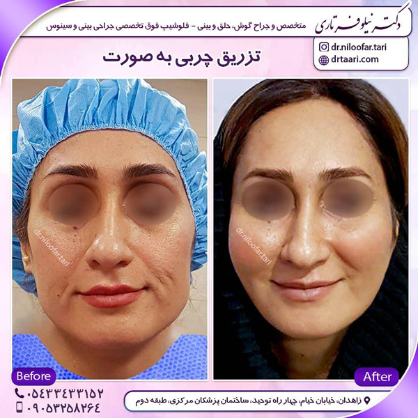 تزریق چربی