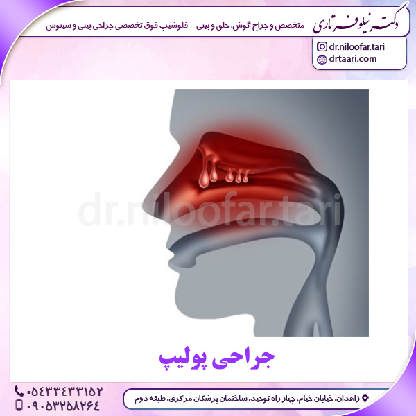 جراحی پولیپ