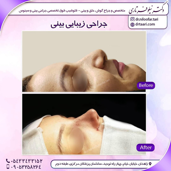 پرسش و پاسخ جراحی بینی
