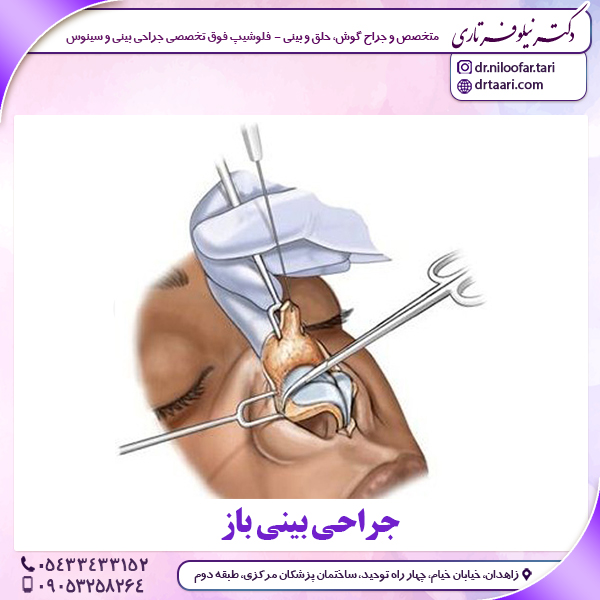 جراحی بینی باز