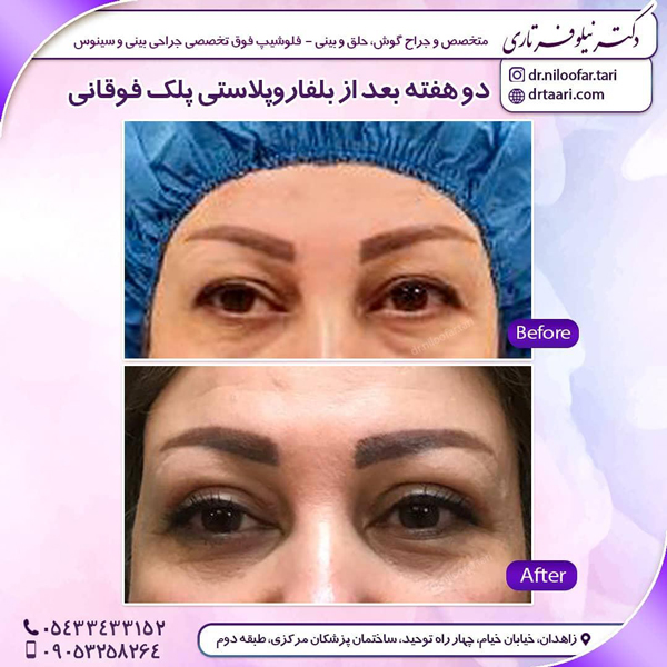 مراقبت های بعد از جراحی پلک _ دکتر تاری