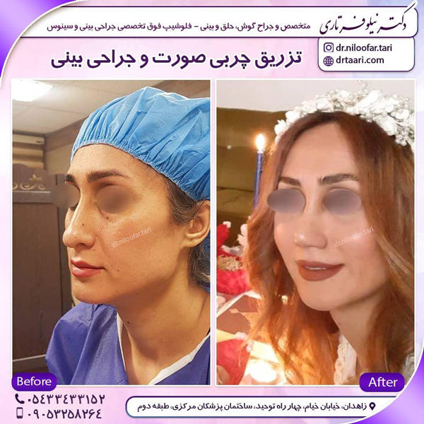 مراقبت های بعد از تزریق چربی