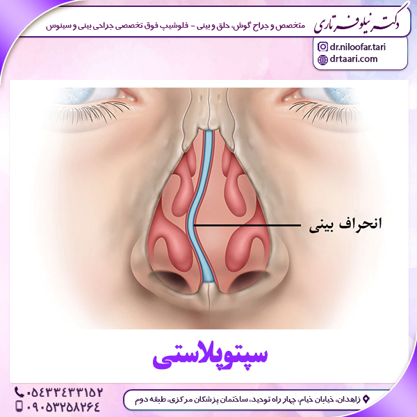 سپتوپلاستی