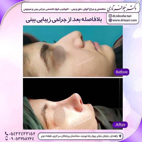 جراحی بینی طبیعی