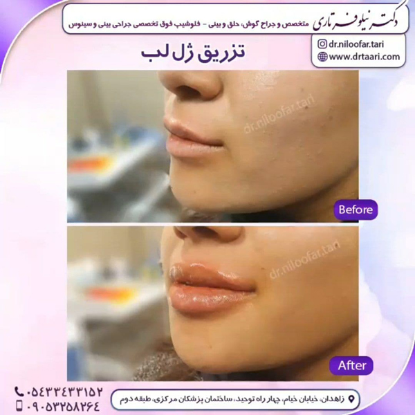 تزریق ژل لب