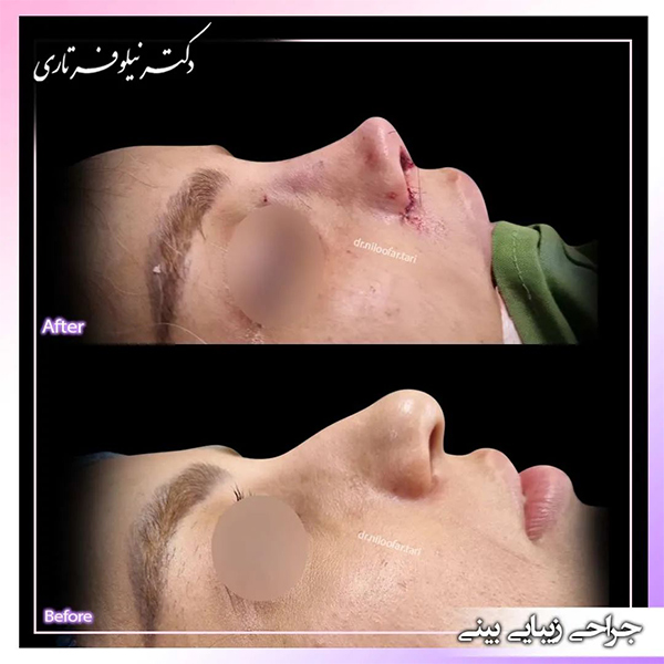 جراحی بینی استخوانی