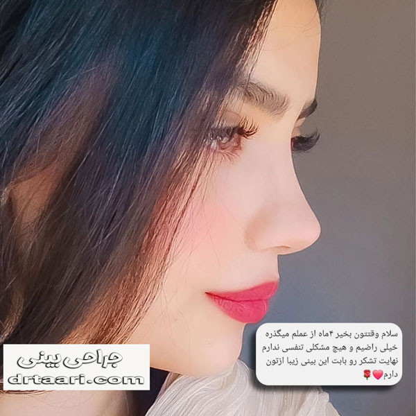 جراحی بینی از دکتر نیلوفر تاری ، بهترین جراح بینی زاهدان