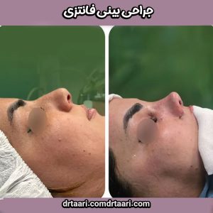 جراحی بینی فانتزی از بهترین جراح بینی در زاهدان