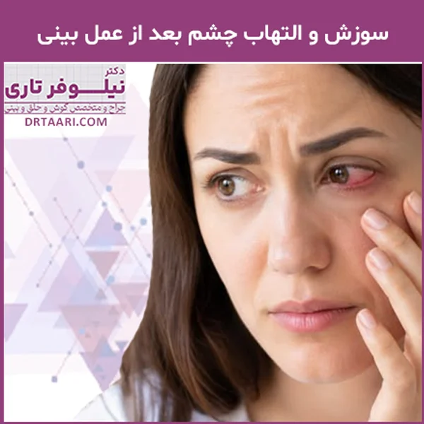 سوزش چشم بعد از عمل بینی - دکتر تاری