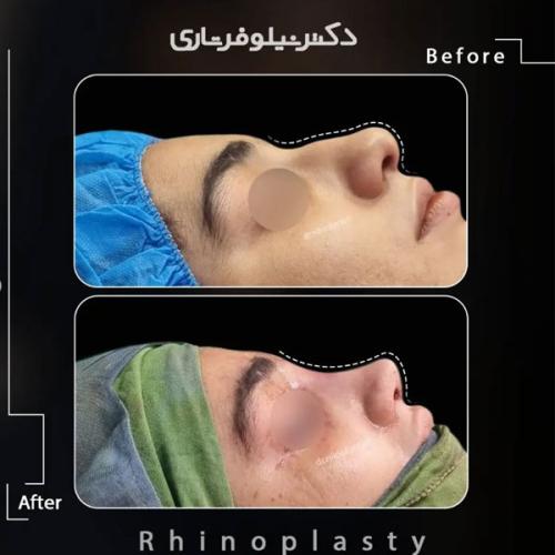 rhinoplasty-.480jpg