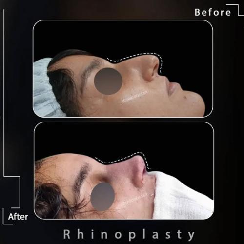 rhinoplasty-.481pg