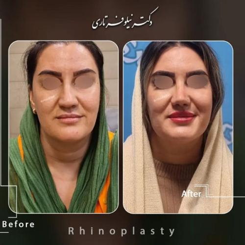 rhinoplasty-.482pg