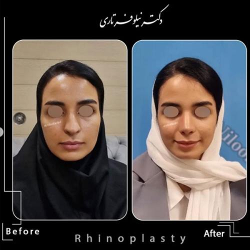 rhinoplasty-.483pg