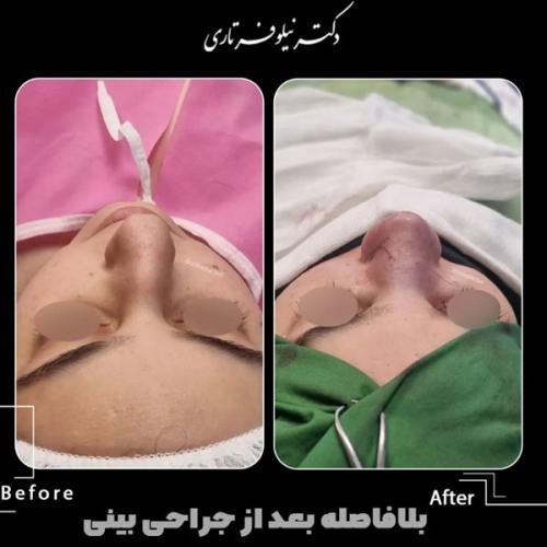 rhinoplasty-.486pg