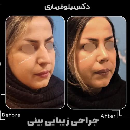 rhinoplasty-.498pg