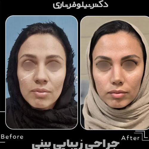 rhinoplasty-.500pg (1)