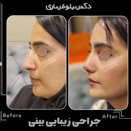 rhinoplasty-.501pg