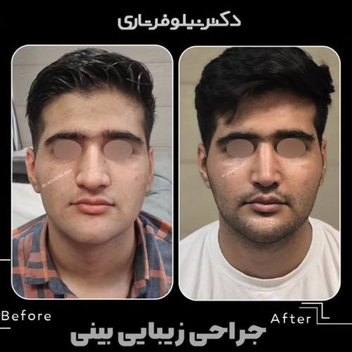 rhinoplasty-.502pg