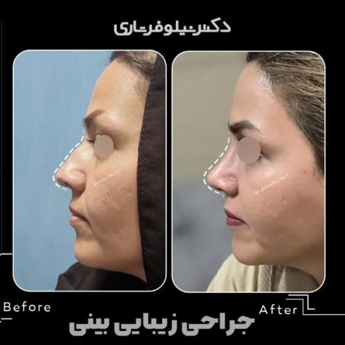 rhinoplasty-.503pg