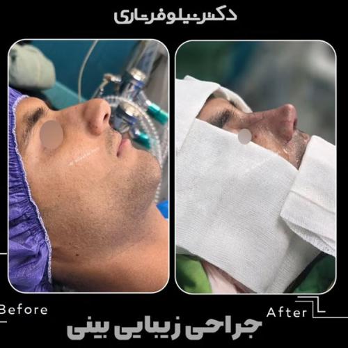 rhinoplasty-.505pg