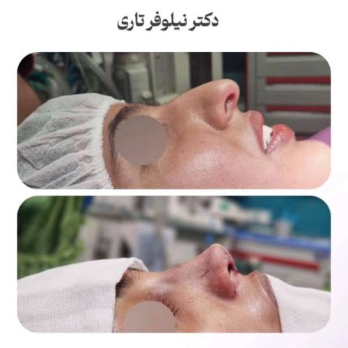 rhinoplasty-.537