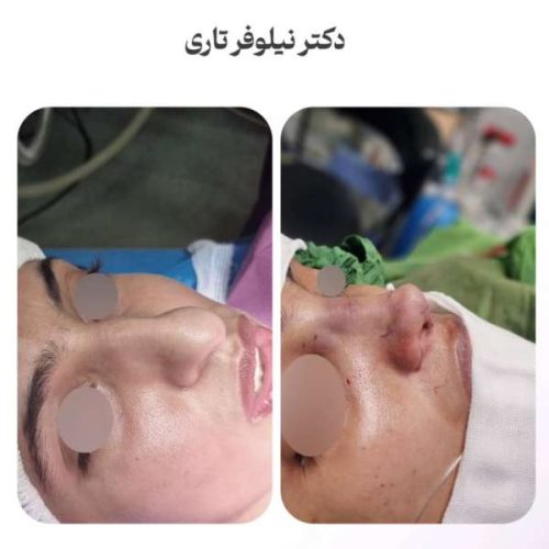 rhinoplasty-.538