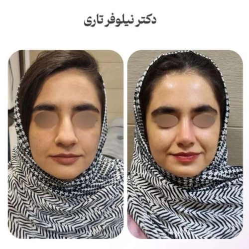 rhinoplasty-.539