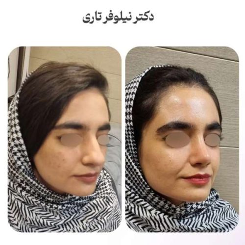 rhinoplasty-.540