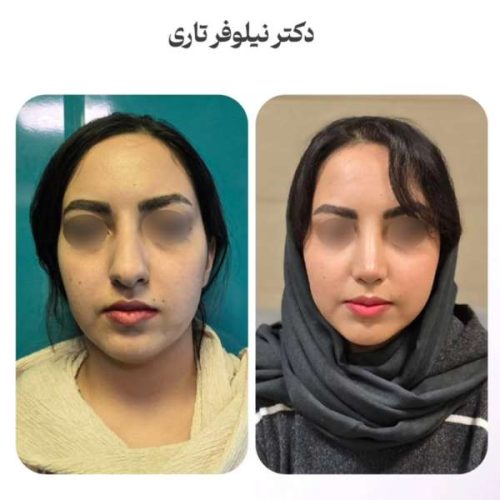 rhinoplasty-.541