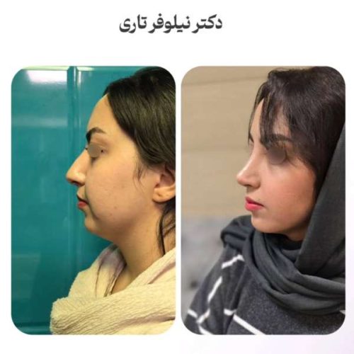 rhinoplasty-.542