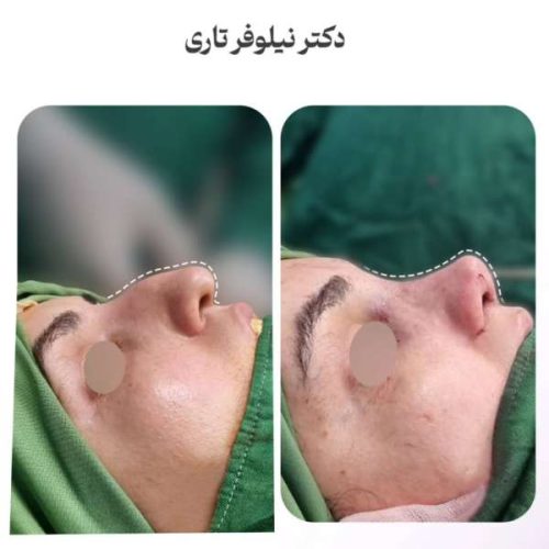 rhinoplasty-.543