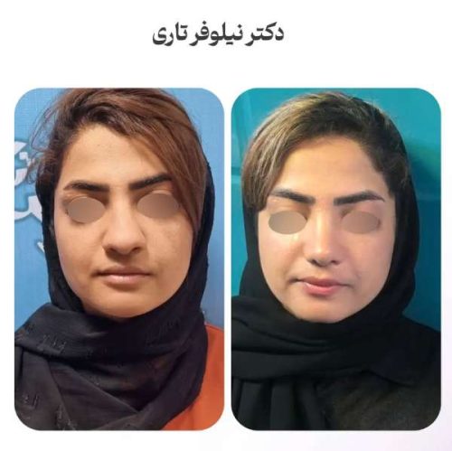 rhinoplasty-.544