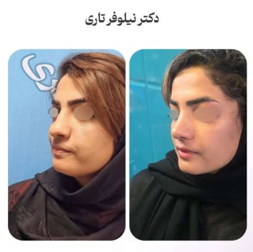 rhinoplasty-.545
