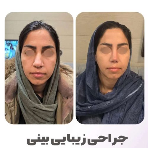 rhinoplasty-546