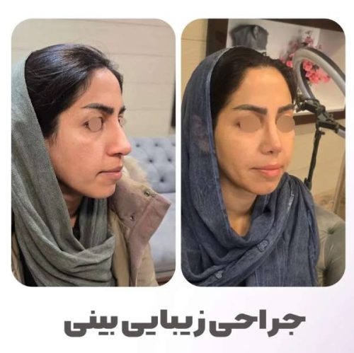 rhinoplasty-547