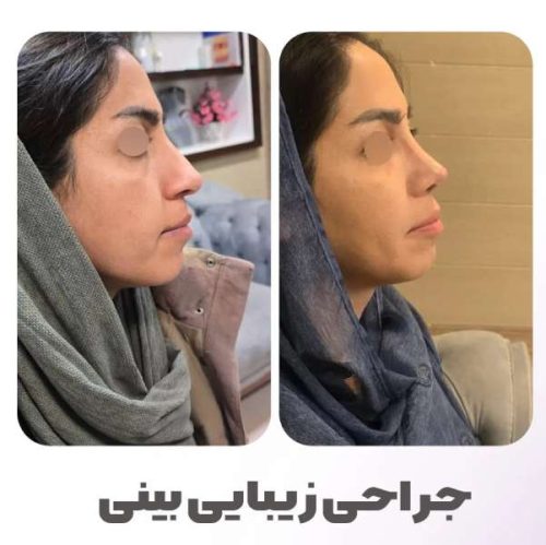 rhinoplasty-548