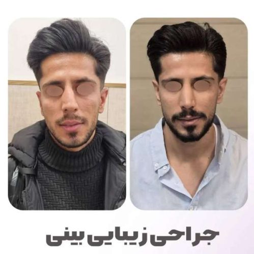 rhinoplasty-549