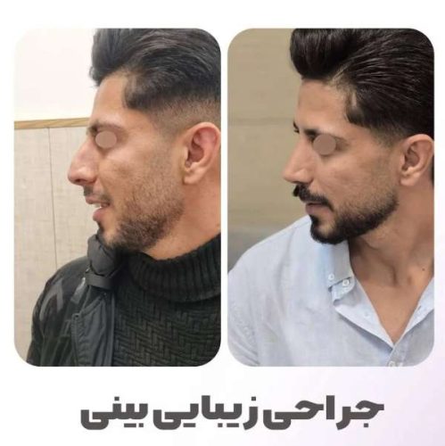 rhinoplasty-550