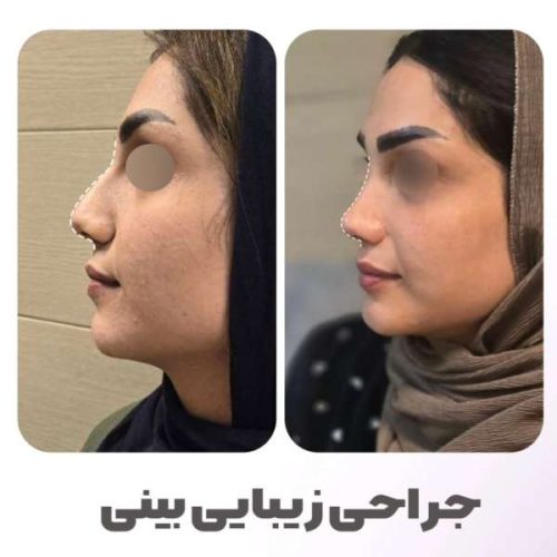 rhinoplasty-551