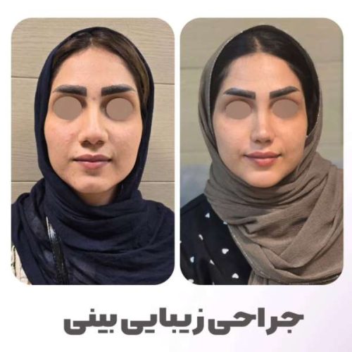 rhinoplasty-552