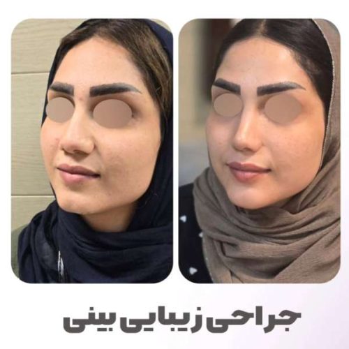 rhinoplasty-553