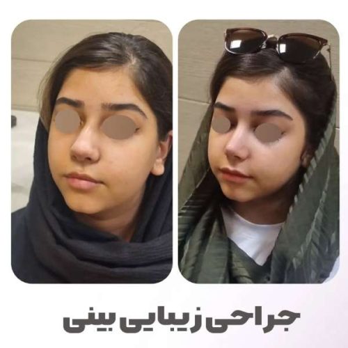 rhinoplasty-555