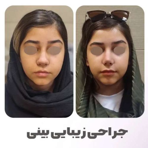 rhinoplasty-556