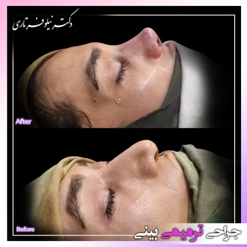 rhinoplasty450