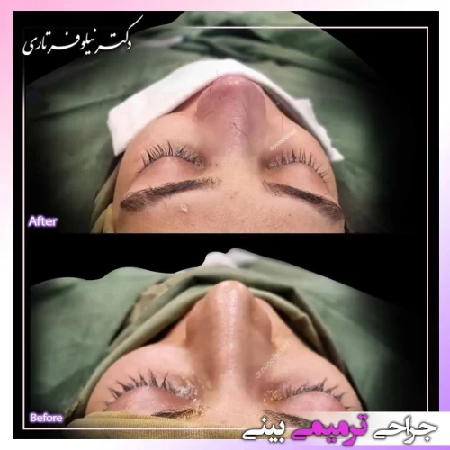 rhinoplasty451