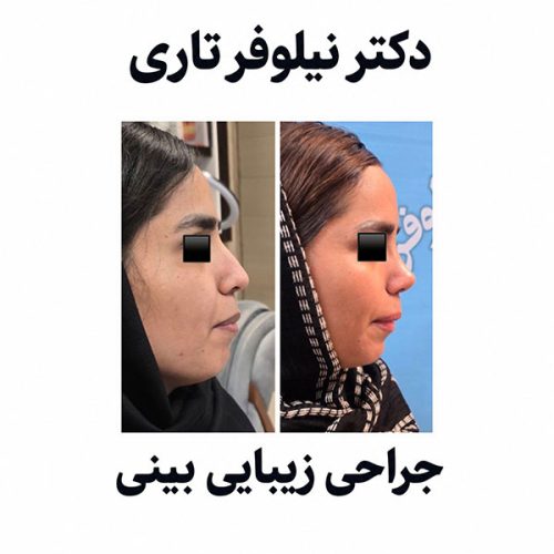 rhinoplasty558