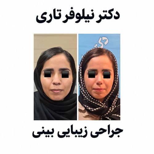 rhinoplasty559