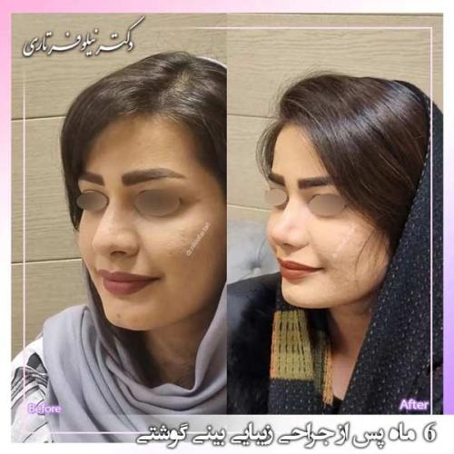 جراحی-بینی-381
